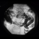 MNGIE, Mitochondrial neurogastrointestinal encephalopathy: RF - Fluoroscopy
