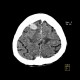 Metastasis in brain, multiple, multiple myeloma: CT - Computed tomography