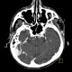 Metastasis in brain, multiple, multiple myeloma: CT - Computed tomography