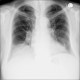 Morgagni hernia with dome of the liver: X-ray - Plain radiograph