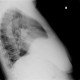 Morgagni hernia with dome of the liver: X-ray - Plain radiograph