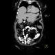 Morgagni hernia with dome of the liver: CT - Computed tomography