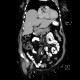 Morgagni hernia with dome of the liver: CT - Computed tomography