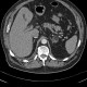Myelolipoma of adrenal gland: CT - Computed tomography
