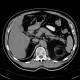 Myelolipoma, adrenal: CT - Computed tomography
