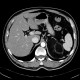 Myelolipoma, adrenal: CT - Computed tomography