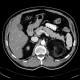 Myelolipoma, adrenal: CT - Computed tomography