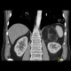 Myelolipoma, adrenal: CT - Computed tomography