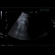 Myelolipoma, adrenal: US - Ultrasound