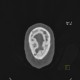 Myeloma of orbit and skull: CT - Computed tomography