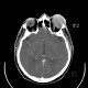 Myeloma of orbit and skull: CT - Computed tomography