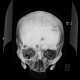 Myeloma of orbit and skull: CT - Computed tomography