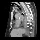 Malposition of nasogastric tube, hemothorax, pneumothorax: CT - Computed tomography