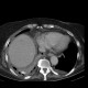 Malposition of nasogastric tube, hemothorax, pneumothorax: CT - Computed tomography