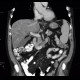 Liver steatosis, geographic, focal: CT - Computed tomography