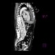 Mediastinal hemorrhage: CT - Computed tomography