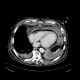Mediastinal hemorrhage: CT - Computed tomography
