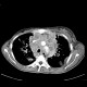 Melanoma of mediastinum: CT - Computed tomography