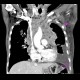 Melanoma of mediastinum: CT - Computed tomography