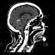 Menigioma of cerebellar tentorium: CT - Computed tomography
