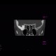 Menigioma en plaque: CT - Computed tomography