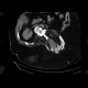 Spina bifida occulta, meningocoele, sacral: CT - Computed tomography