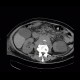 Lymphoma, mesenterial lymphadenopathy, edema of mesentery, correlation: CT - Computed tomography