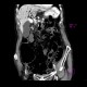 Mesenterial occlusion, gas in portal vein: CT - Computed tomography