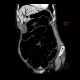 Mesenterial occlusion, gas in portal vein: CT - Computed tomography