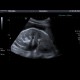 Hydronephrosis, mild edema of kidney: US - Ultrasound