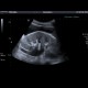Hydronephrosis, mild edema of kidney: US - Ultrasound
