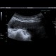Liver metastasis, peritoneal carcinomatosis: US - Ultrasound