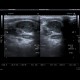Metastatic infiltration of lymph nodes: US - Ultrasound
