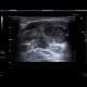 Metastatic infiltration of lymph nodes: US - Ultrasound