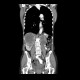 Kidney metastasis of lung carcinoma: CT - Computed tomography