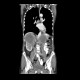 Kidney metastasis of lung carcinoma: CT - Computed tomography