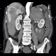 Neuroendocrine tumour of adrenal gland, liver metastasis, necrotic: CT - Computed tomography