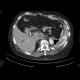 Metastatic disease of brain, lung, liver: CT - Computed tomography