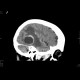 Metastatic disease of brain, lung, liver: CT - Computed tomography