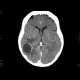 Metastatic disease of brain, lung, liver: CT - Computed tomography