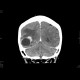 Metastatic disease of brain, lung, liver: CT - Computed tomography