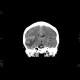 Metastatic disease of brain, lung, liver: CT - Computed tomography