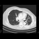 Metastatic disease of brain, lung, liver: CT - Computed tomography