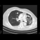 Metastatic disease of brain, lung, liver: CT - Computed tomography