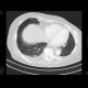 Metastatic disease of brain, lung, liver: CT - Computed tomography