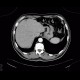 Focal hepatopathy, falciform ligament: CT - Computed tomography