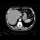 Focal hepatopathy, falciform ligament: CT - Computed tomography