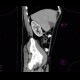 Focal hepatopathy, falciform ligament: CT - Computed tomography