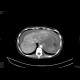 Multiple visceral thromboses of unknown etiology: CT - Computed tomography