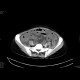 Multiple visceral thromboses of unknown etiology: CT - Computed tomography